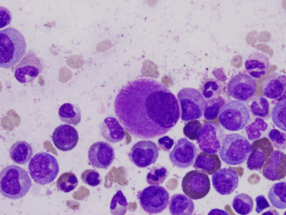 Un piccolo megacariocita con nucleo ipolobato in un aspirato di midollo osseo di un paziente affetto da leucemia mieloide cronica