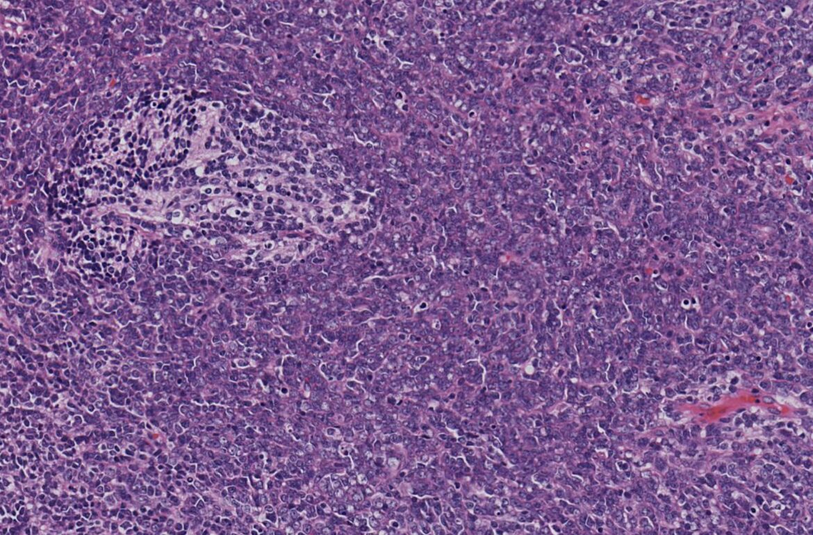 Medulloblastoma